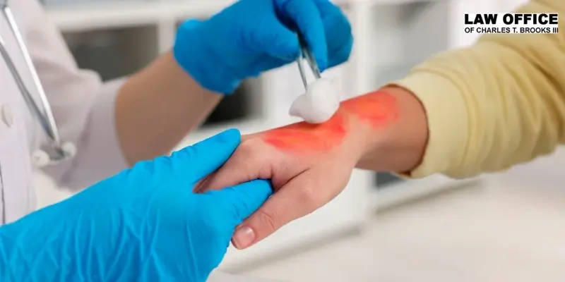 best burn injury lawyer in columbia